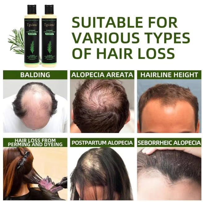 Tgideas Organic Rosemary Shampoo – Boost Growth & Reduce Hair Fall